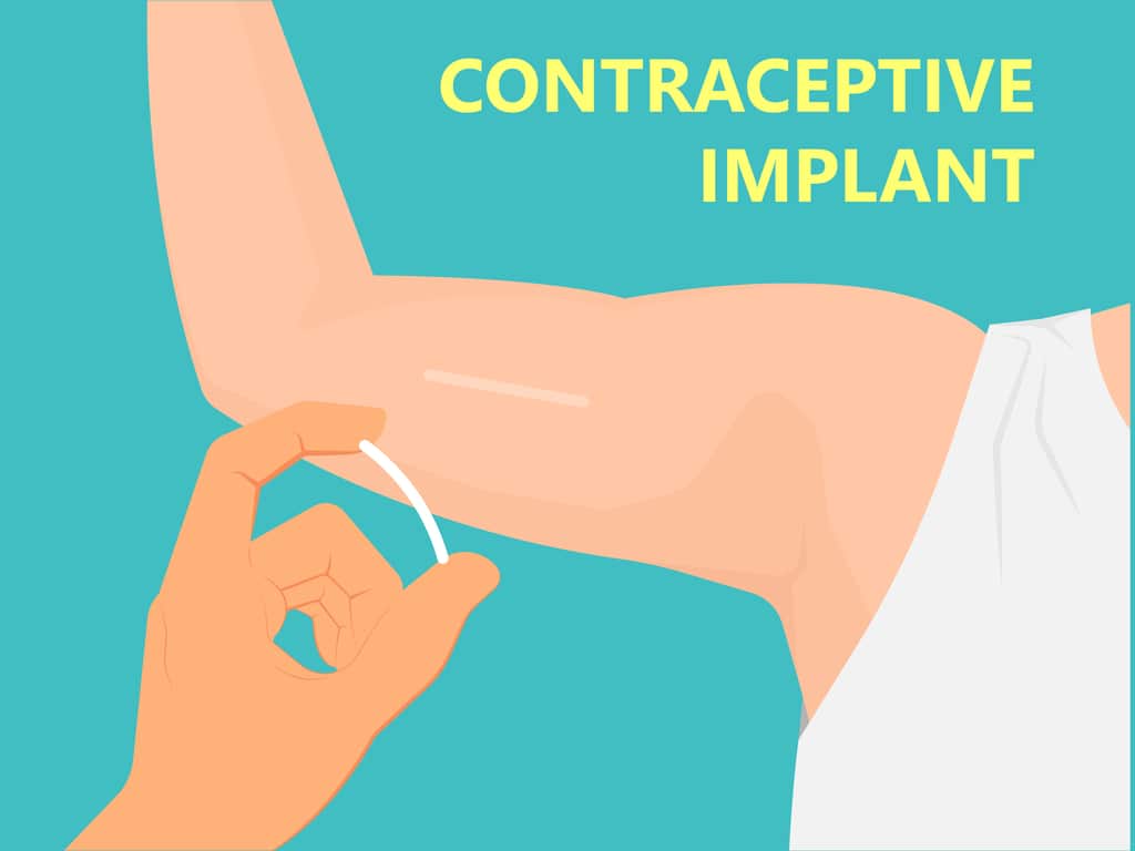 Birth Control Implant | Nexplanon | Risks And Side Effects.