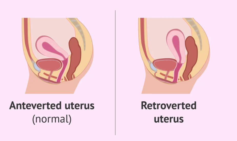 A retroverted uterus is a uterus that curves in a backwards position at the cervix instead of a forward position. 