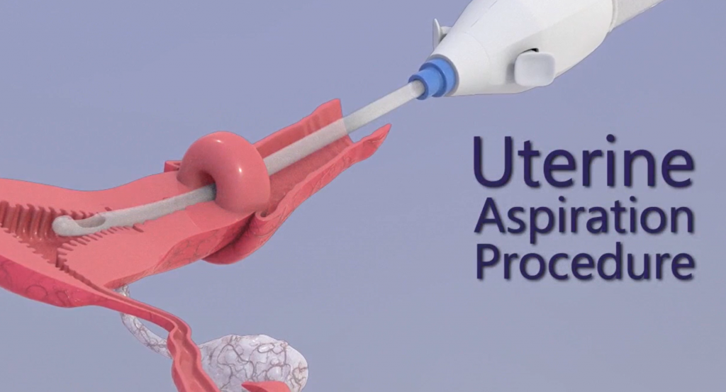 Vacuum aspiration is the most frequently used method to perform first trimester abortions in the United States. 