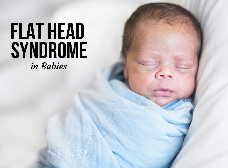 Plagiocephaly In Babies | Tips To Avoid Flat Head Syndrome.