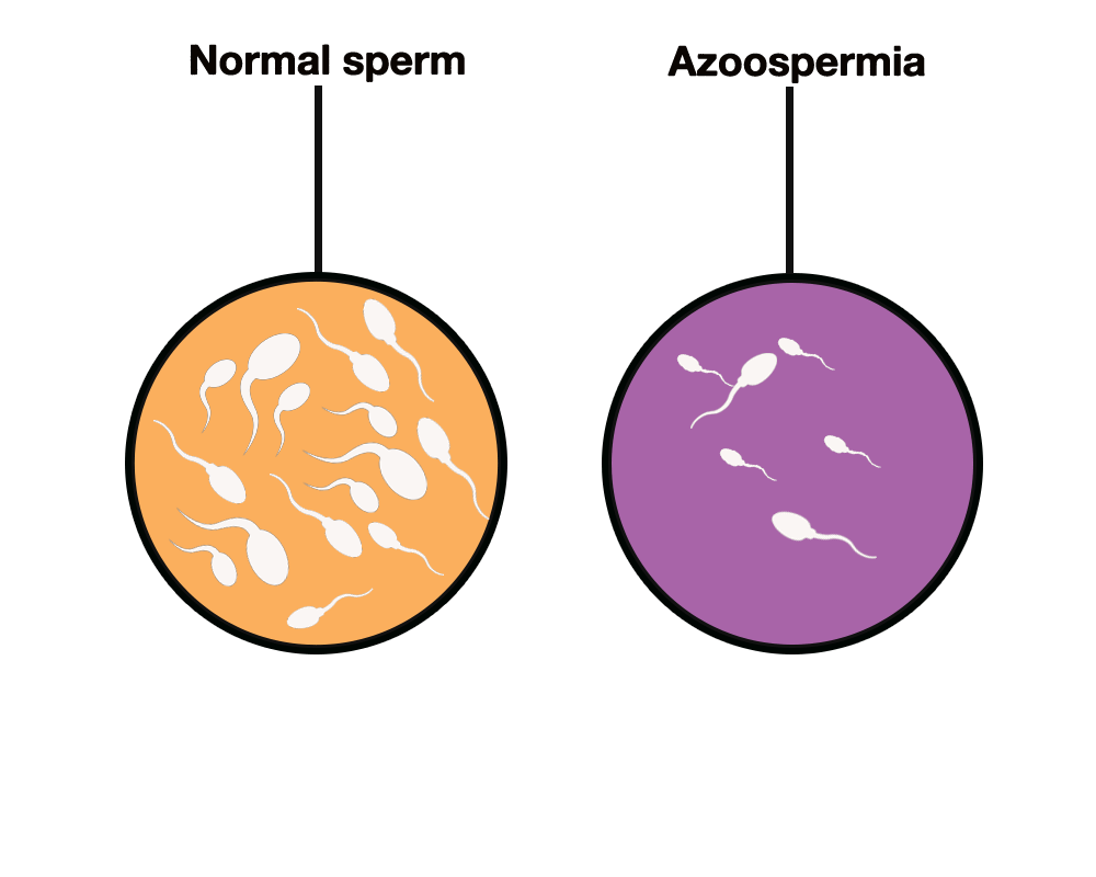 Azoospermia is a condition in which there's no measurable sperm in a man's ejaculate (semen). 