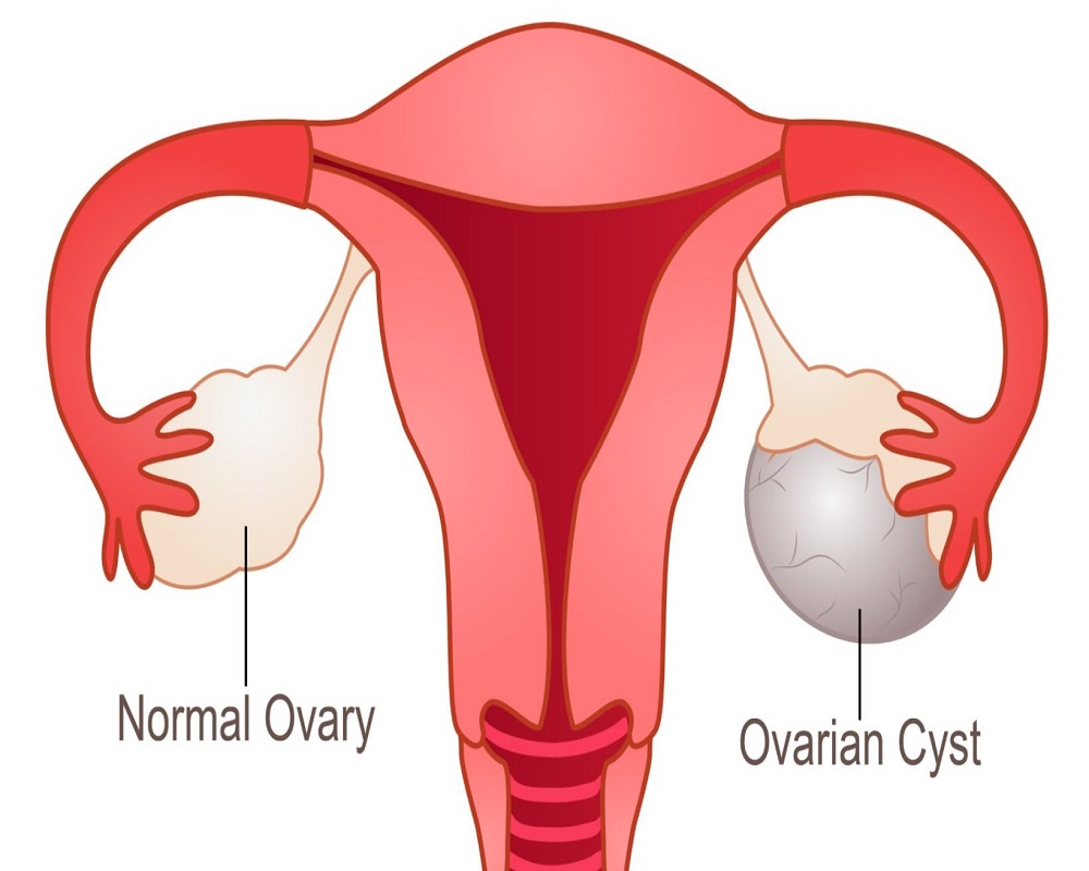 Ovarian cysts are solid or fluid-filled pockets in or on your ovary.