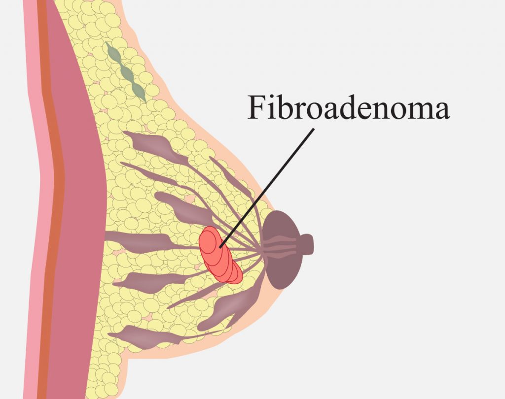 Fibroadenomas are benign tumors that can develop in the breast tissue.