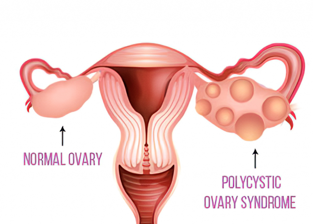 Polycystic ovary syndrome is a condition in which a woman's hormones are out of balance.