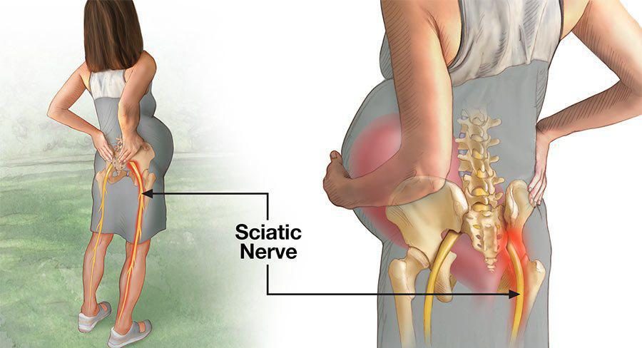 9 Tips to Relieve Sciatica During Pregnancy.