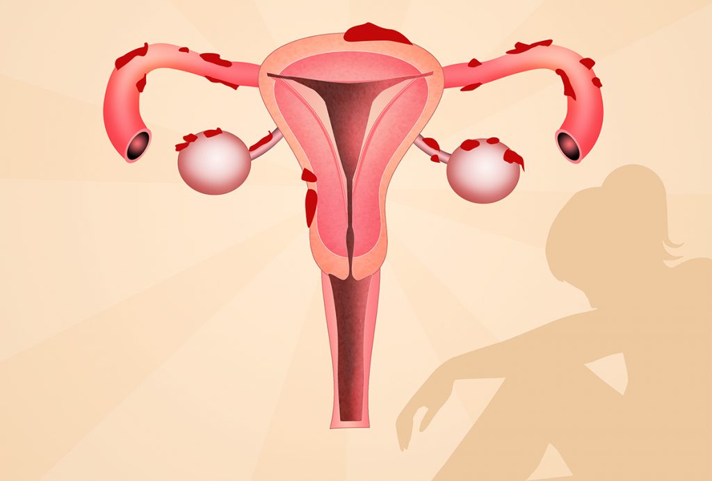 Endometriosis happens when tissue normally found inside the uterus grows in other parts of the body.