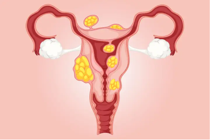 Uterine fibroids are noncancerous growths of the uterus that often appear during childbearing years. 